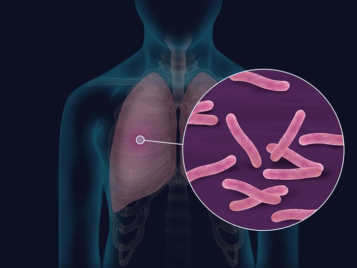 Lao màng phổi là một trong những bệnh thông thường do vi khuẩn Mycobacterium Tuberculosis gây ra