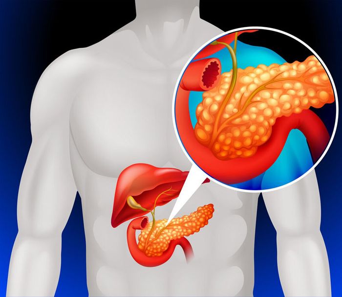 Viêm tuyến tụy cấp tính có nguồn gốc từ nhiều nguyên nhân khác nhau.