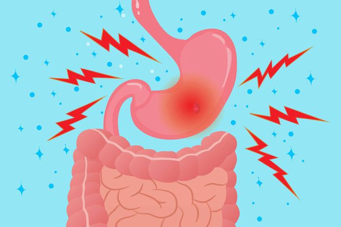 Viêm phù nề hang vị dạ dày có phải là bệnh cấp tính không?