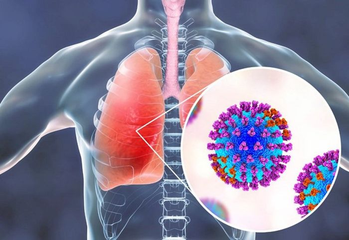 Viêm phổi thường xảy ra ở phần dưới của hệ hô hấp.