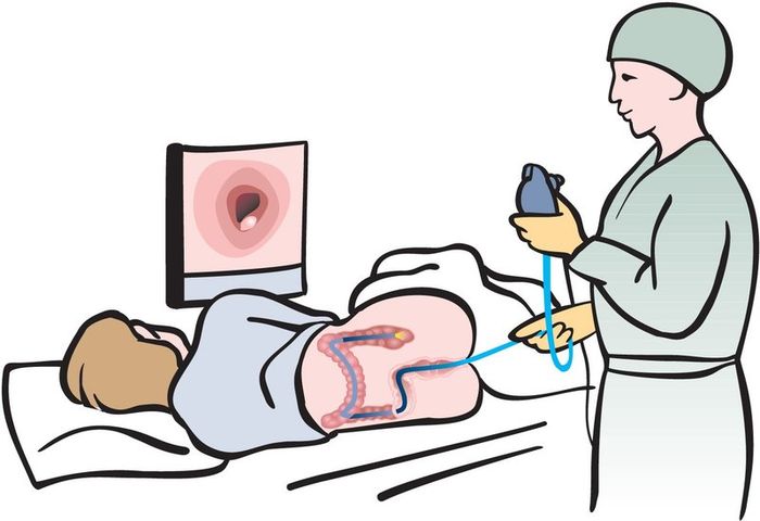 Nội soi đại tràng là phương pháp giúp chẩn đoán bệnh viêm ruột mạnh mẽ