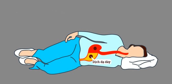 Nằm nghiêng sang trái cũng là phương pháp tốt cho bệnh trào ngược dạ dày
