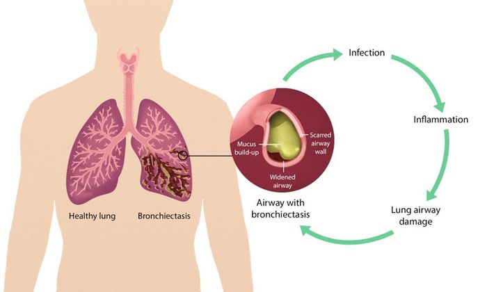 Liệu tình trạng giãn phế quản có nguy hiểm không?