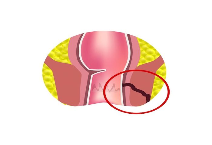 Vết rò hậu môn
