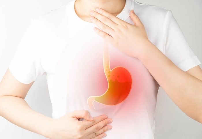Ợ nóng có thể là do bệnh reflux dạ dày gây ra