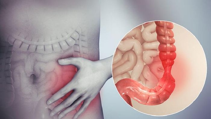 Co thắt đại tràng và một số thông tin quan trọng
