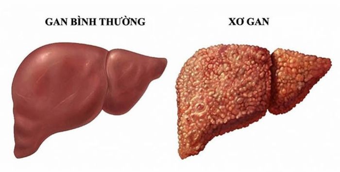 Người mắc phải xơ gan nặng có thể gặp phải hôn mê gan mạn tính.