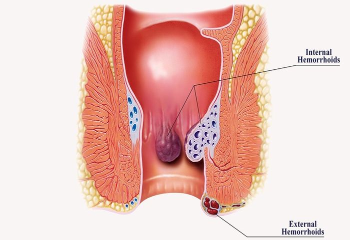 Bệnh trĩ có thể gây ra các biến chứng nguy hiểm