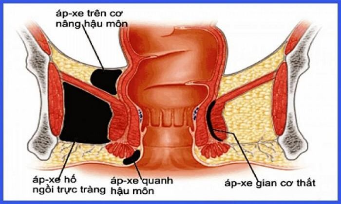 Áp xe gây ra tình trạng sưng, đau và chảy mủ ở hậu môn