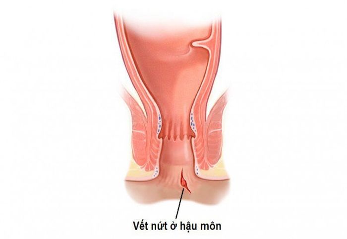 Bệnh nứt kẽ hậu môn