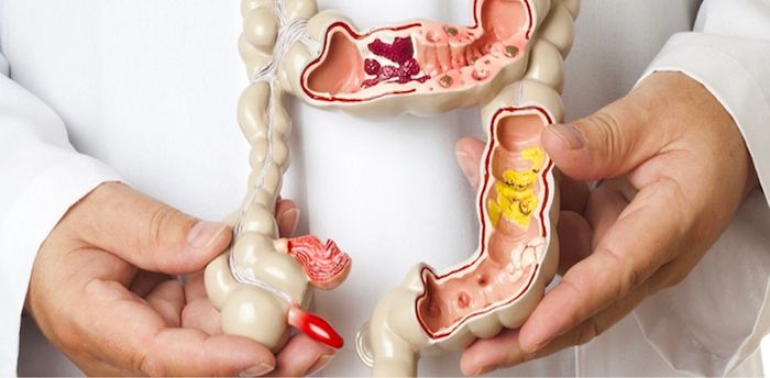 Các nguyên nhân có thể gây ra tình trạng sa trực tràng