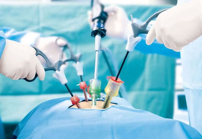 Một ca mổ ruột thừa thường kéo dài từ 30 đến 60 phút