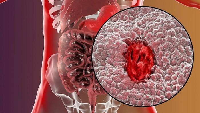 Cảnh báo về bất thường từ dấu hiệu đau bao tử