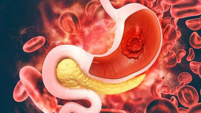Ung thư dạ dày gây ra các triệu chứng đau bao tử nghiêm trọng