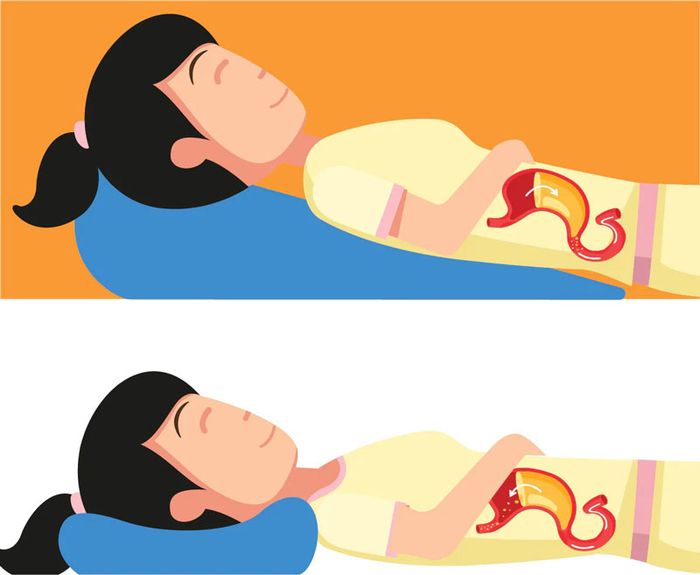 Nằm sấp với đầu nâng giúp giảm trào ngược dạ dày