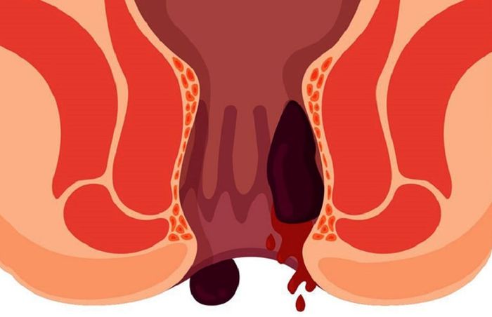 Người mắc bệnh trĩ thường gặp tình trạng chảy máu hậu môn khi đi tiêu