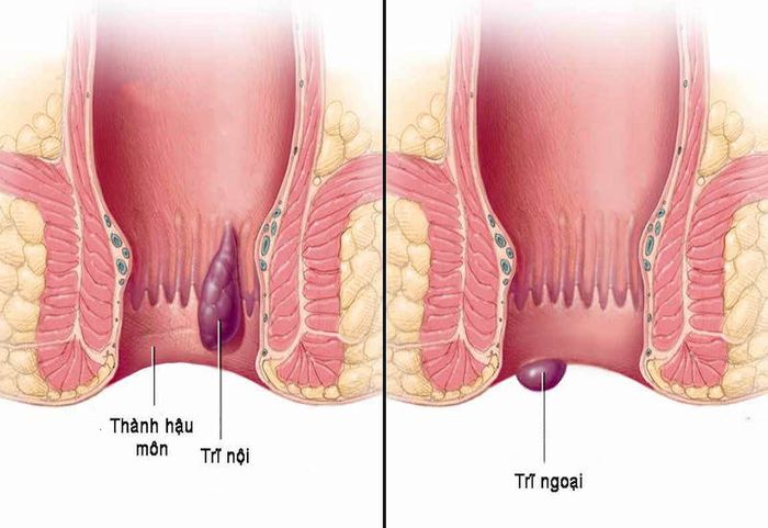 Trĩ nội và trĩ ngoại