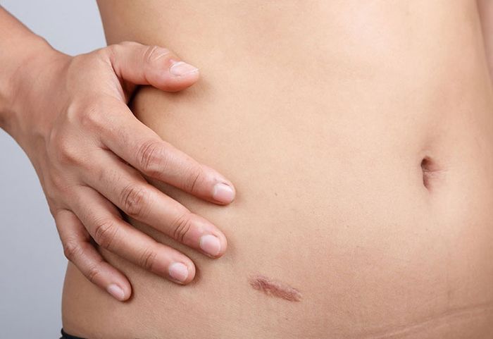Nếu không chăm sóc vết thương sau phẫu thuật một cách cẩn thận, có thể dẫn đến biến chứng.