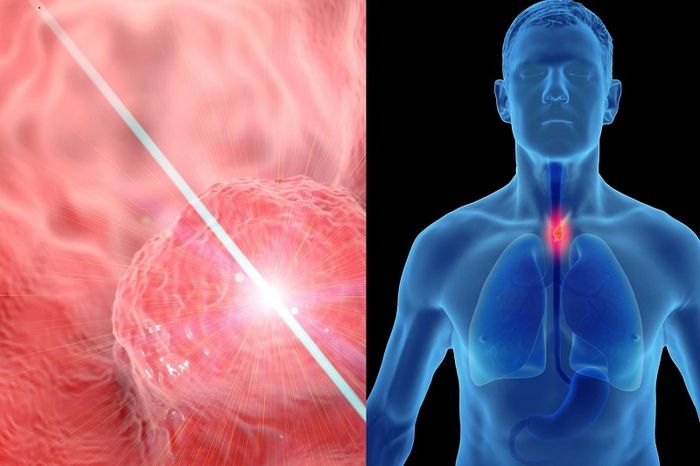 Bệnh về co thắt tâm vị dạ dày kéo dài có thể dẫn đến ung thư