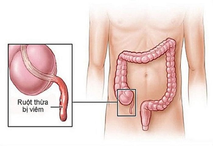 Khi ruột thừa viêm, cần phải phẫu thuật ngay