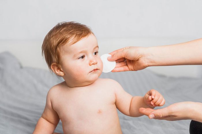Một số trẻ bị teo đường mật có biểu hiện vàng da