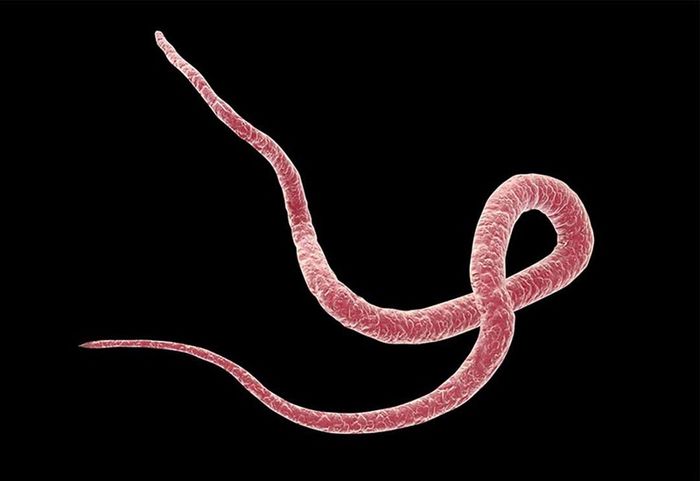 Viêm tắc ruột hoại tử có thể do nhiễm giun đũa