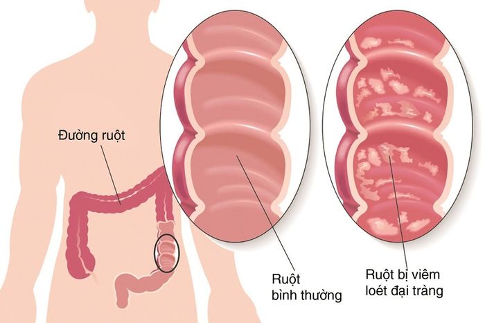 Viêm đại tràng là nguyên nhân phổ biến gây ra tình trạng đi ngoài không thành khuôn