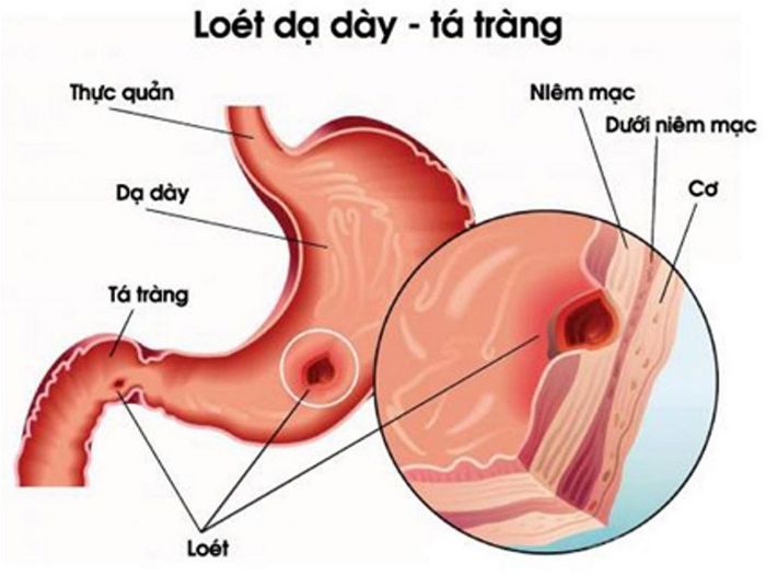 Tổn thương từ viêm loét dạ dày có thể dẫn đến tình trạng đau bụng âm ỉ và tiêu chảy