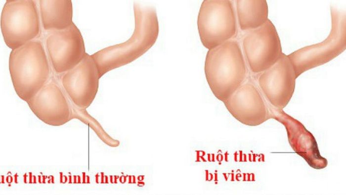 Thụt tháo đại tràng không phù hợp với những người mắc bệnh viêm ruột thừa.