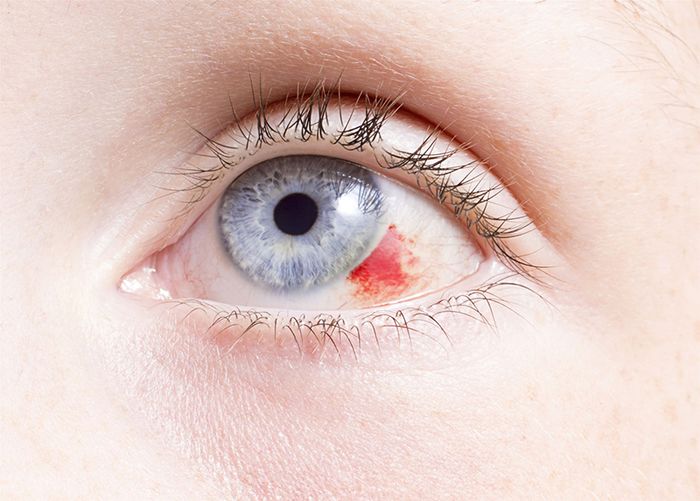 Xuất huyết dưới kết mạc mắt gây ra tình trạng mắt đỏ.