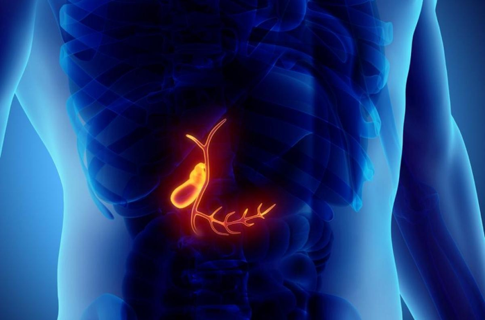 Sỏi mật là loại sỏi hình thành từ cholesterol và các sắc tố mật
