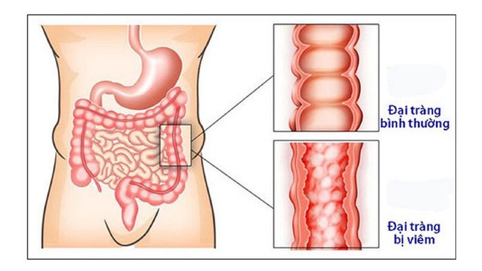 Đau bụng dưới ở nam giới có thể là do viêm đại tràng