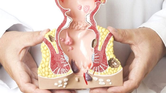 Búi trĩ bị lòi ra ngoài hậu môn khi người bệnh đi đại tiện quá lâu.
