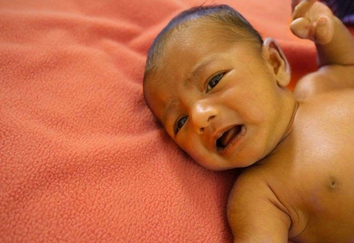 Một trong các dấu hiệu của teo đường mật bẩm sinh là việc trẻ có làn da vàng kéo dài hơn 2 tuần.