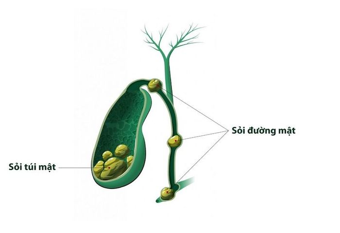 Sỏi có thể tồn tại trong túi mật hoặc trong đường mật