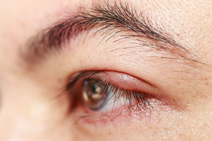 Mắt đỏ là triệu chứng của viêm mi mắt