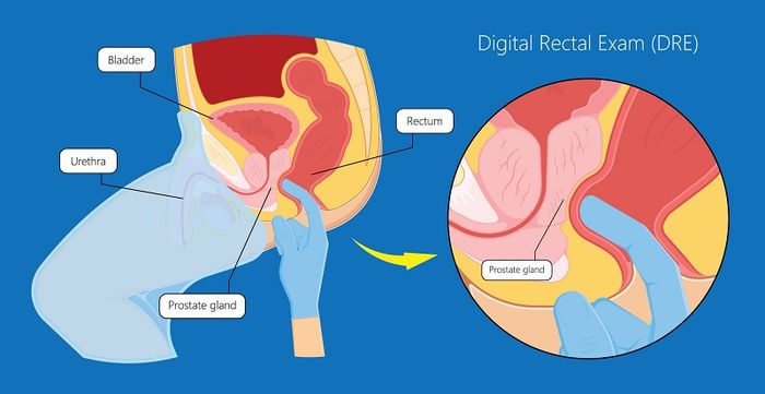 Quá trình khám bệnh trĩ bao gồm những gì?