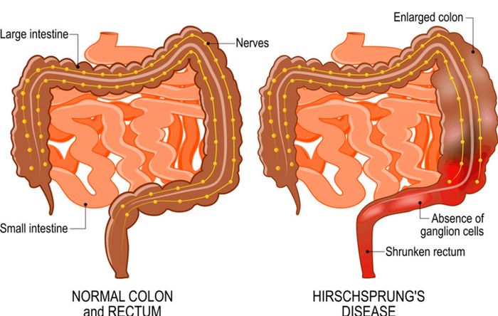 Cha mẹ cần theo dõi để phát hiện có trẻ sơ sinh mắc bệnh phình đại tràng bẩm sinh không?