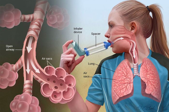 Phương pháp điều trị hen phế quản
