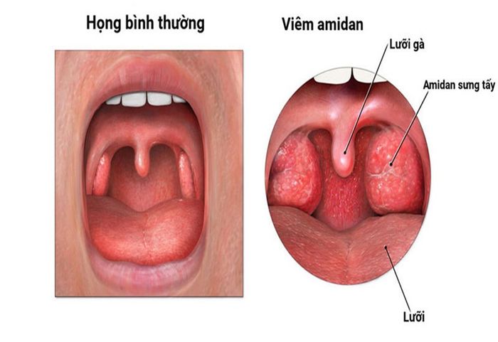Các trường hợp thường phải cắt amidan
