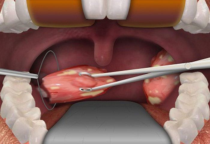 Phẫu thuật cắt bỏ amidan thường được thực hiện trong một thời gian ngắn