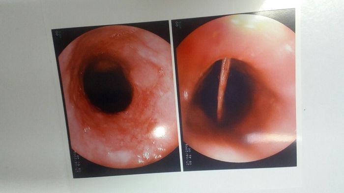 Ngày nay, quá trình nội soi thực quản không còn gây khó chịu cho người bệnh