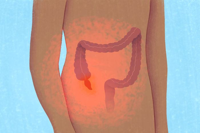 Đau bụng đi ngoài cùng sốt, nôn, ói có thể là do viêm ruột thừa