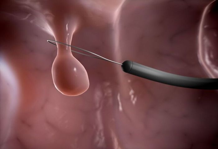 Thủ thuật để loại bỏ Polyp hậu môn