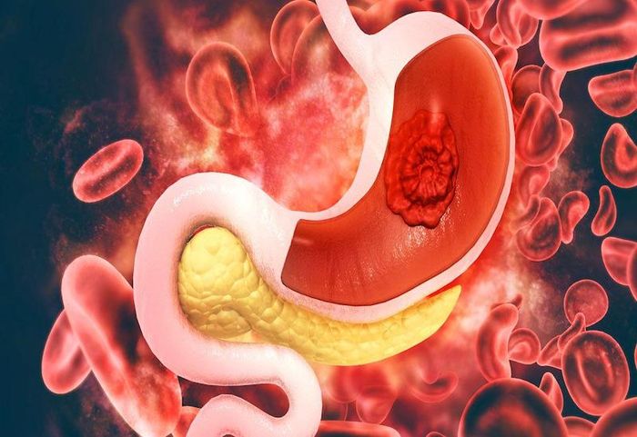 Ung thư dạ dày cũng là nguyên nhân dẫn đến chảy máu tiêu hóa
