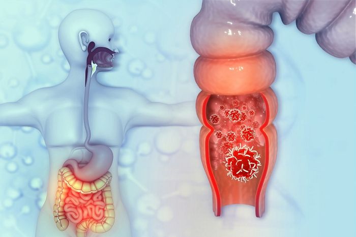 Không Nên Chủ Quan Với Các Bệnh Lý Thường Gặp Ở Trực Tràng
