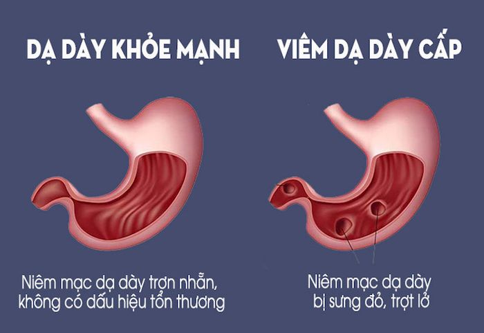 Trạng thái niêm mạc dạ dày khi khỏe mạnh và khi gặp viêm dạ dày cấp
