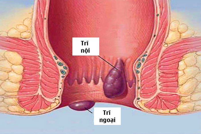 Táo bón kéo dài có thể gây ra bệnh trĩ cho trẻ