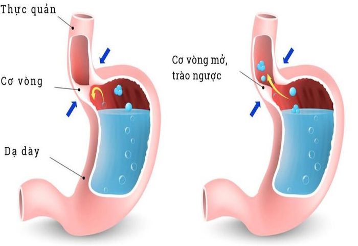 Sự hoạt động bình thường của van dạ dày thực quản và tình trạng bị hở