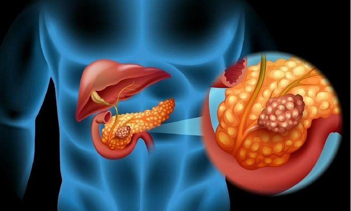 Điều trị ung thư tụy là quá trình rất phức tạp.